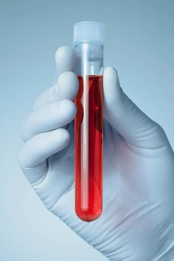 Autoimmune-Treatment A close-up of a doctor's gloved hand holding a vial a plasma, signifying autoimmune disease treatment in Newfoundland.
